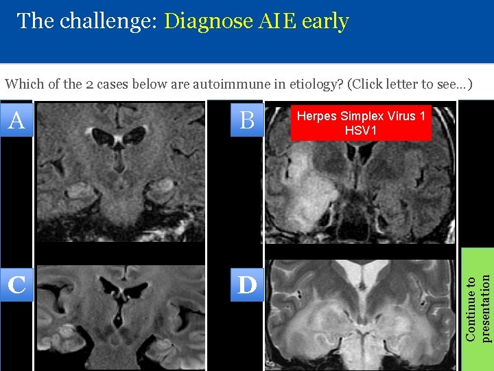 The challenge: Diagnose AIE early Which of the 2 cases below are autoimmune in