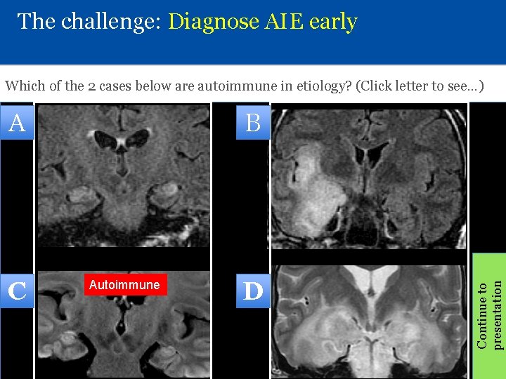 The challenge: Diagnose AIE early Which of the 2 cases below are autoimmune in