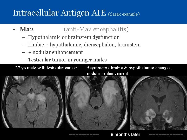 Intracellular Antigen AIE (classic example) • Ma 2 – – (anti-Ma 2 encephalitis) Hypothalamic