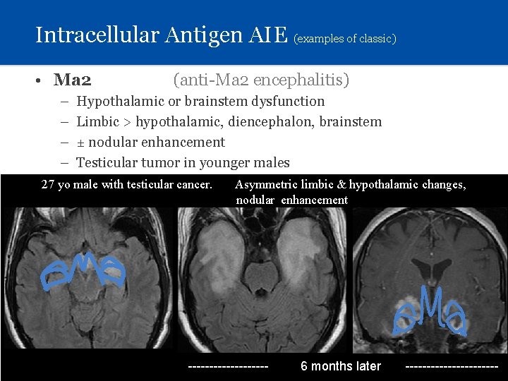 Intracellular Antigen AIE (examples of classic) • Ma 2 – – (anti-Ma 2 encephalitis)