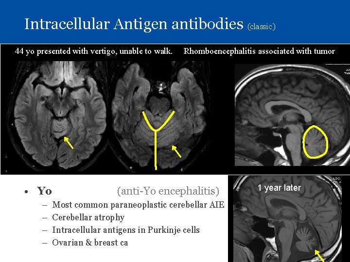 Intracellular Antigen antibodies (classic) 44 yo presented with vertigo, unable to walk. Rhomboencephalitis associated