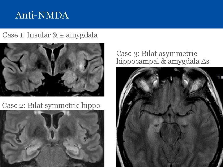 Anti-NMDA Case 1: Insular & ± amygdala Case 3: Bilat asymmetric hippocampal & amygdala