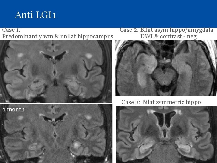 Anti LGI 1 Case 1: Predominantly wm & unilat hippocampus Case 2: Bilat asym