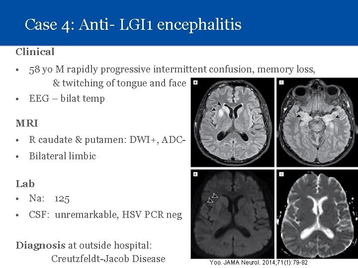 Case 4: Anti- LGI 1 encephalitis Clinical • 58 yo M rapidly progressive intermittent