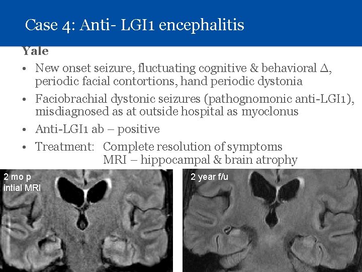 Case 4: Anti- LGI 1 encephalitis Yale • New onset seizure, fluctuating cognitive &