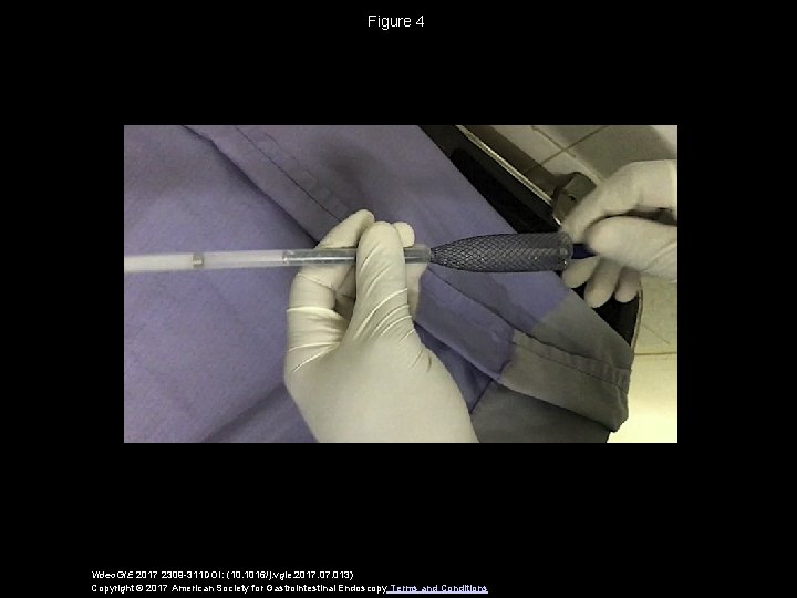 Figure 4 Video. GIE 2017 2309 -311 DOI: (10. 1016/j. vgie. 2017. 013) Copyright