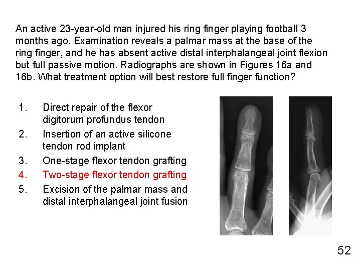 An active 23 -year-old man injured his ring finger playing football 3 months ago.