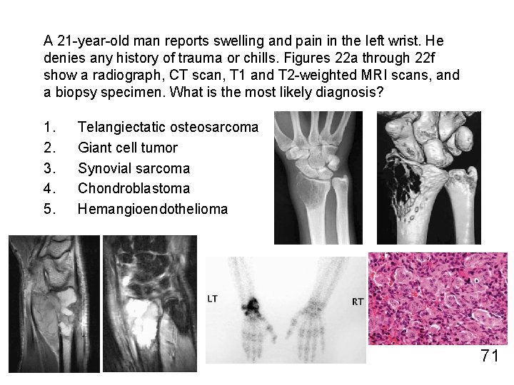 A 21 -year-old man reports swelling and pain in the left wrist. He denies