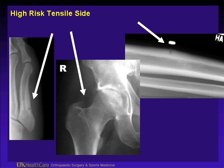 High Risk Tensile Side 