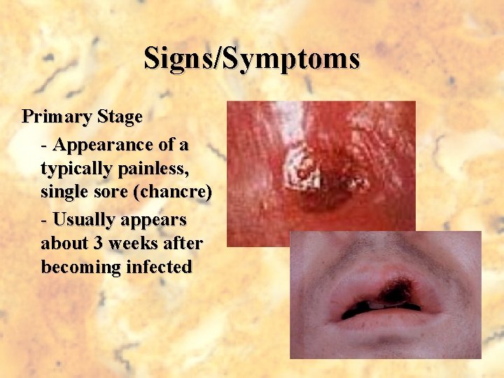 Signs/Symptoms Primary Stage - Appearance of a typically painless, single sore (chancre) - Usually