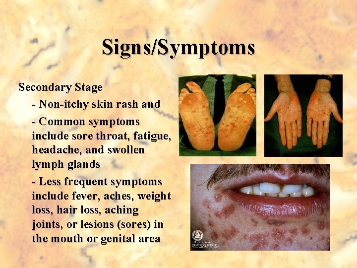Signs/Symptoms Secondary Stage - Non-itchy skin rash and - Common symptoms include sore throat,