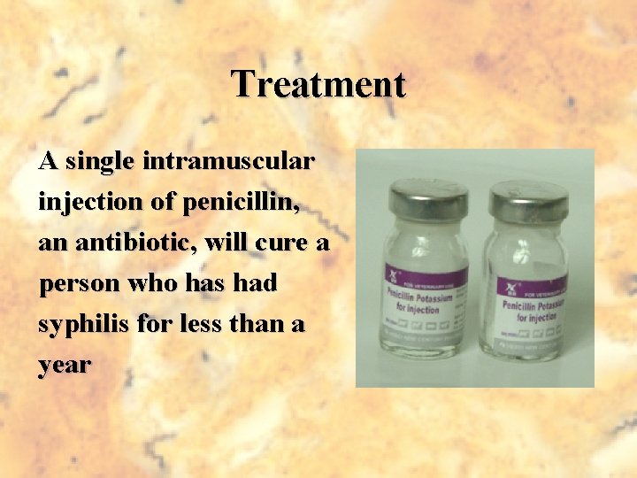 Treatment A single intramuscular injection of penicillin, an antibiotic, will cure a person who