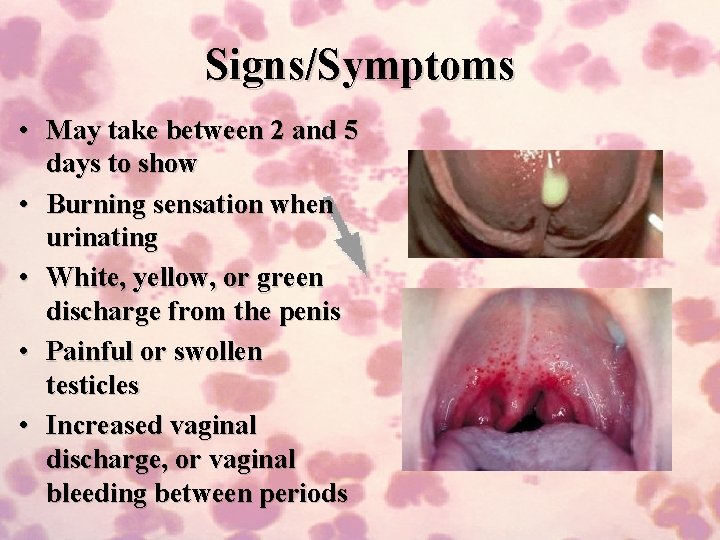 Signs/Symptoms • May take between 2 and 5 days to show • Burning sensation