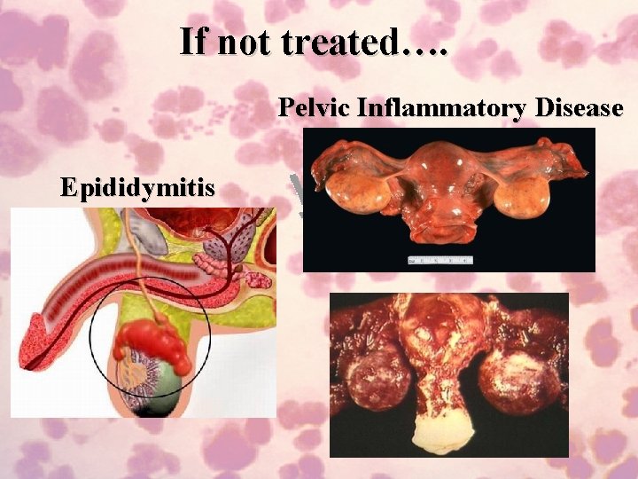 If not treated…. Pelvic Inflammatory Disease Epididymitis 