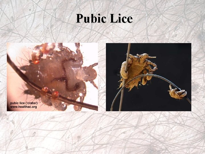 Pubic Lice 