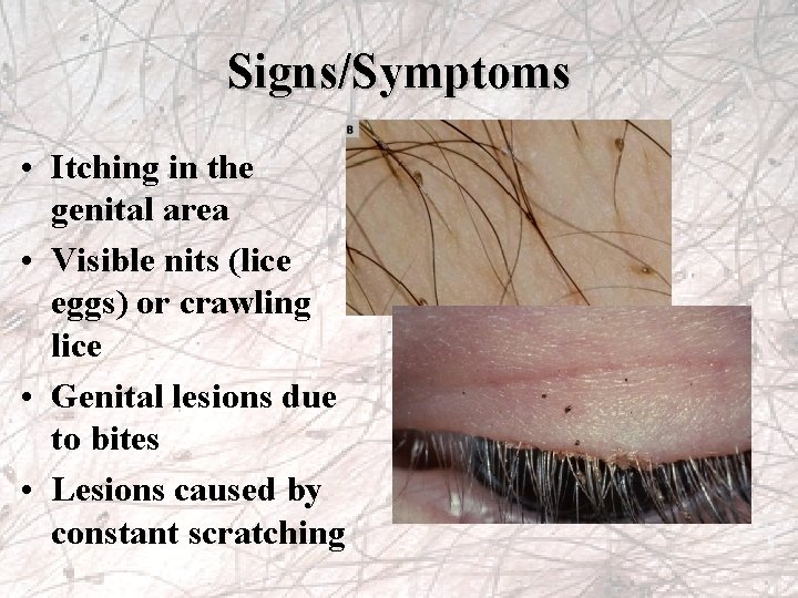 Signs/Symptoms • Itching in the genital area • Visible nits (lice eggs) or crawling