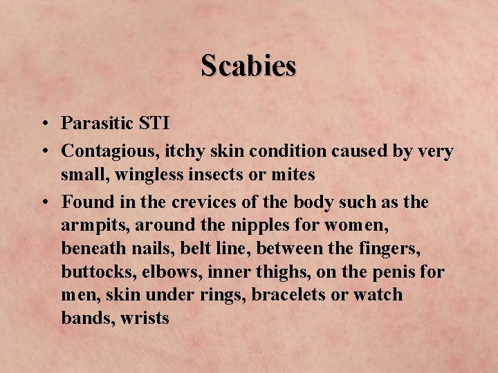 Scabies • Parasitic STI • Contagious, itchy skin condition caused by very small, wingless