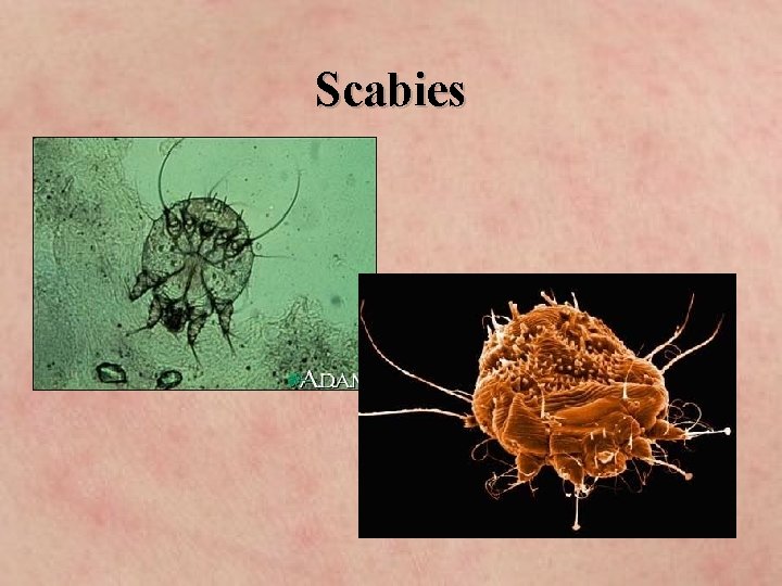 Scabies 