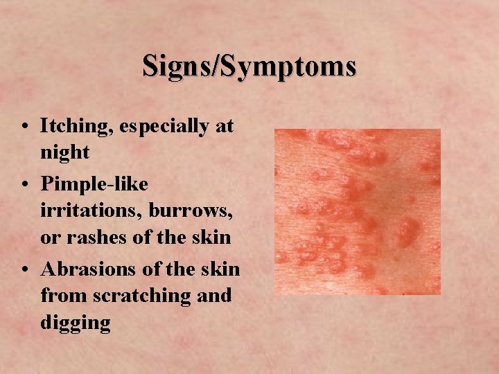 Signs/Symptoms • Itching, especially at night • Pimple-like irritations, burrows, or rashes of the