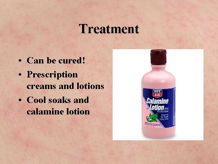 Treatment • Can be cured! • Prescription creams and lotions • Cool soaks and