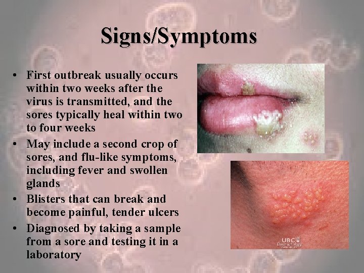 Signs/Symptoms • First outbreak usually occurs within two weeks after the virus is transmitted,