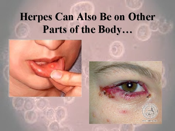 Herpes Can Also Be on Other Parts of the Body… 