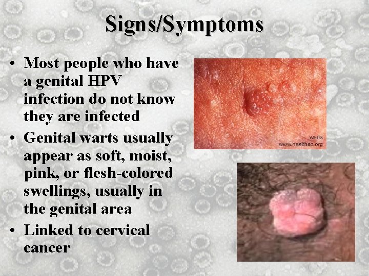 Signs/Symptoms • Most people who have a genital HPV infection do not know they