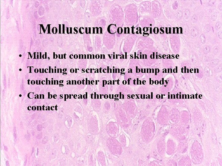 Molluscum Contagiosum • Mild, but common viral skin disease • Touching or scratching a