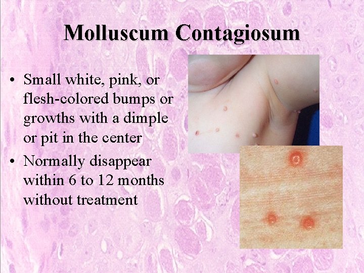 Molluscum Contagiosum • Small white, pink, or flesh-colored bumps or growths with a dimple