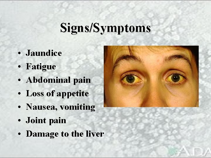 Signs/Symptoms • • Jaundice Fatigue Abdominal pain Loss of appetite Nausea, vomiting Joint pain