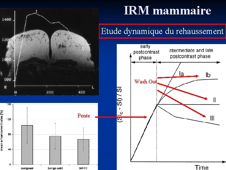 IRM mammaire Etude dynamique du rehaussement Wash Out Pente 