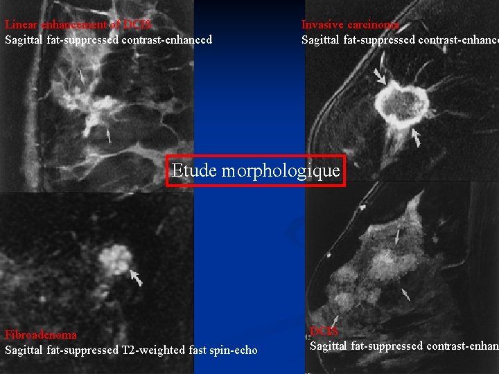 Linear enhancement of DCIS Sagittal fat-suppressed contrast-enhanced Invasive carcinoma Sagittal fat-suppressed contrast-enhance Etude morphologique