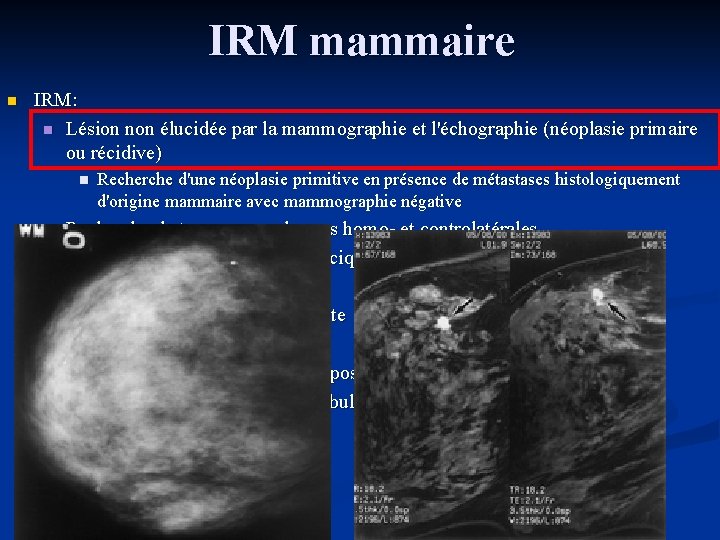 IRM mammaire n IRM: n Lésion non élucidée par la mammographie et l'échographie (néoplasie