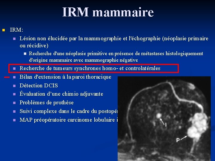 IRM mammaire n IRM: n Lésion non élucidée par la mammographie et l'échographie (néoplasie