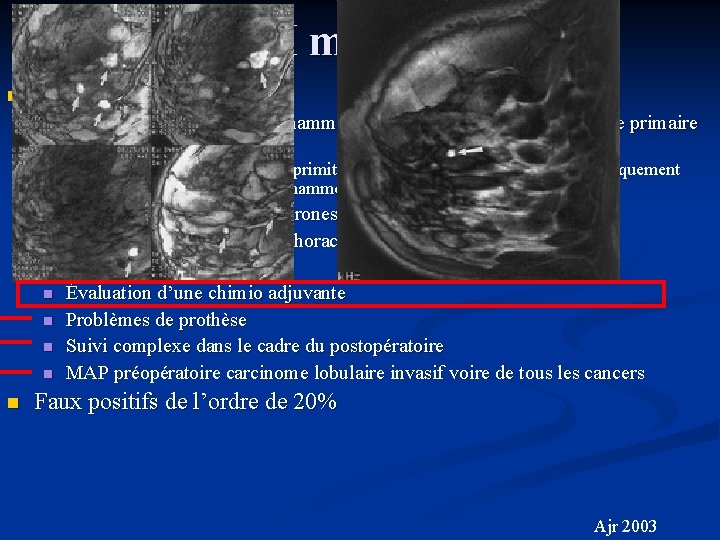 IRM mammaire n IRM: n Lésion non élucidée par la mammographie et l'échographie (néoplasie