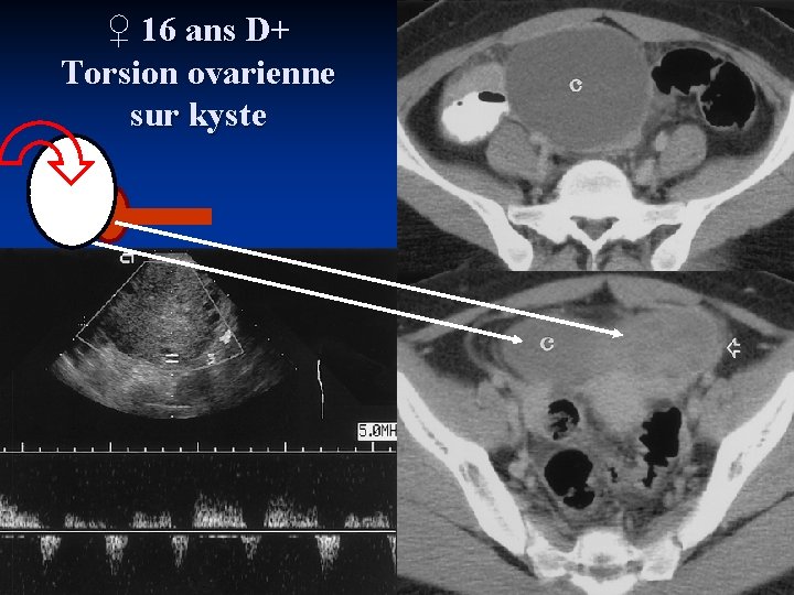 ♀ 16 ans D+ Torsion ovarienne sur kyste K 