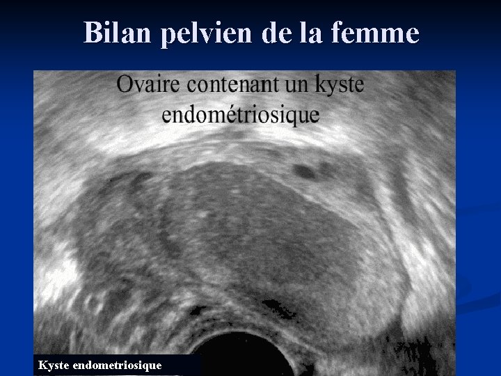 Bilan pelvien de la femme Kyste endometriosique 