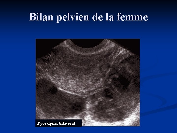 Bilan pelvien de la femme Pyosalpinx bilatéral 