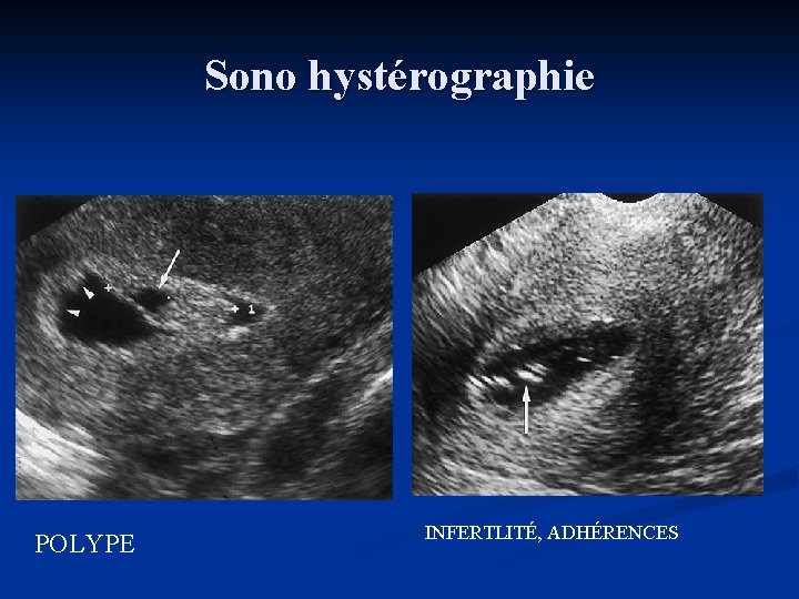 Sono hystérographie POLYPE INFERTLITÉ, ADHÉRENCES 