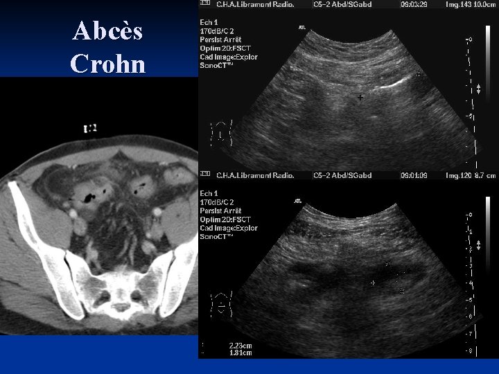 Abcès Crohn 