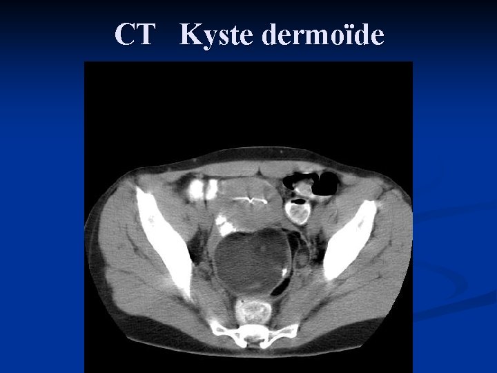 CT Kyste dermoïde 