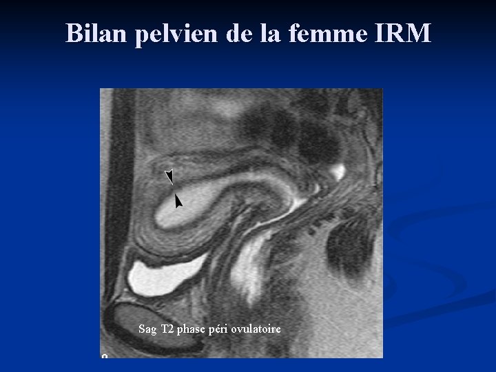 Bilan pelvien de la femme IRM Sag T 2 phase péri ovulatoire 