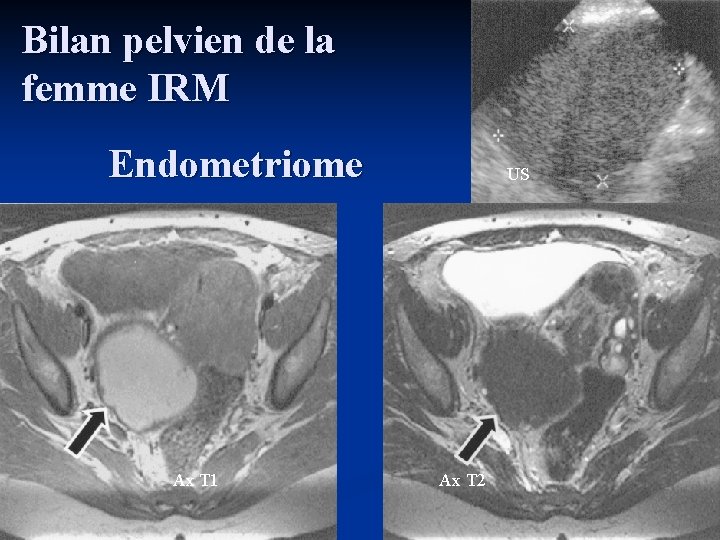 Bilan pelvien de la femme IRM Endometriome Ax T 1 US Ax T 2