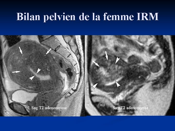 Bilan pelvien de la femme IRM Sag T 2 adenomyose 