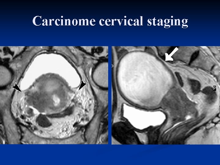 Carcinome cervical staging Stage IIb 