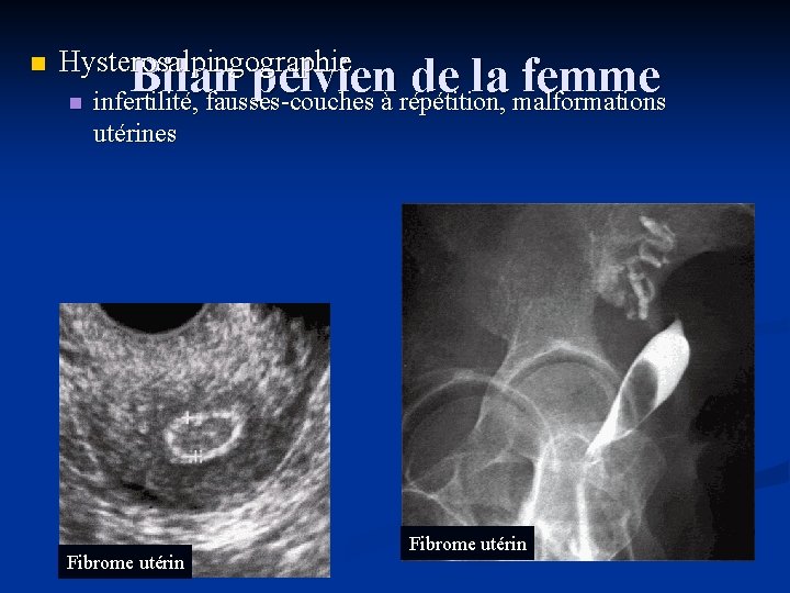 n Hysterosalpingographie n Bilan pelvien de la femme infertilité, fausses-couches à répétition, malformations utérines