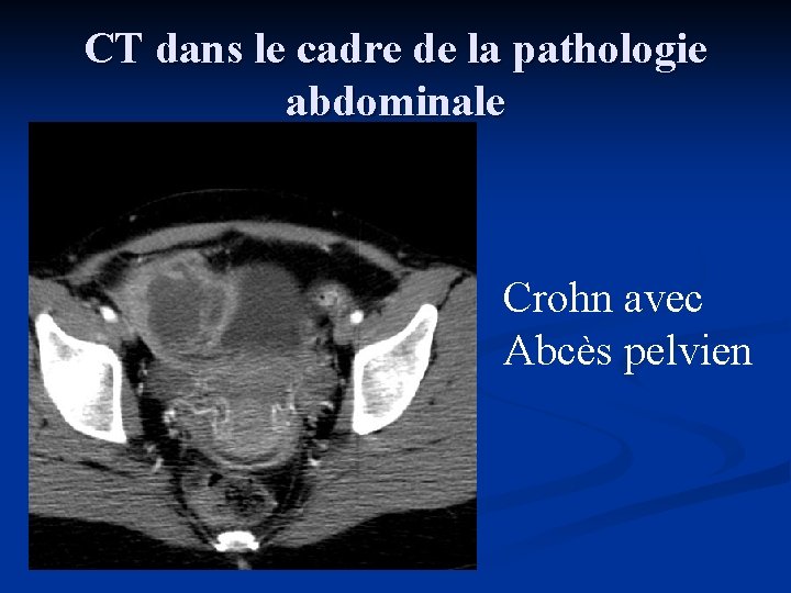 CT dans le cadre de la pathologie abdominale Crohn avec Abcès pelvien 