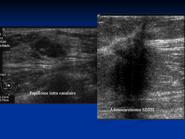 Papillome intra canalaire Adenocarcinome SBRII 