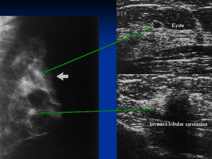 Kyste Invasive lobular carcinoma 