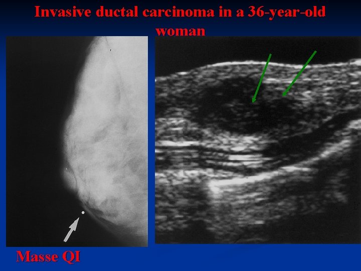 Invasive ductal carcinoma in a 36 -year-old woman Masse QI 